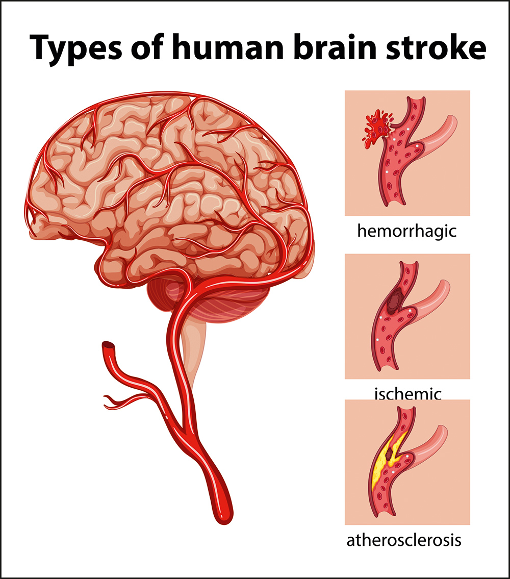 Translating stroke biomarkers for patient benefit - Clinical Laboratory ...