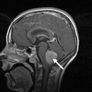 Rapid and reliable detection of medulloblastoma-associated DNA ...