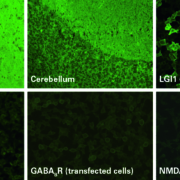 Fig 1 LGI1 positive