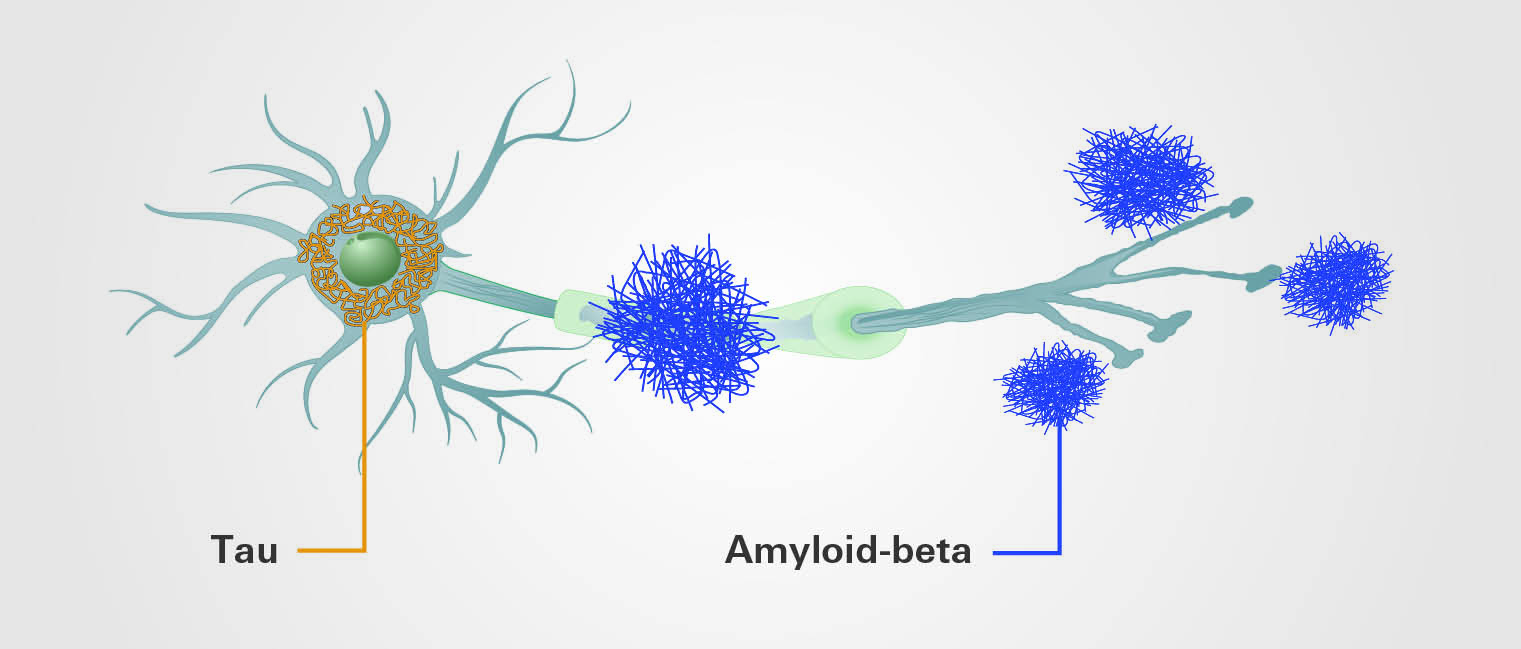 Figure 1. Amyloid-beta and tau deposits in Alzheimer’s disease pathology