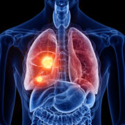 Novel approach to proficiency testing allows insight into areas for improvement in non-small cell lung cancer biomarker analysis 1 AdobeStock 282277137