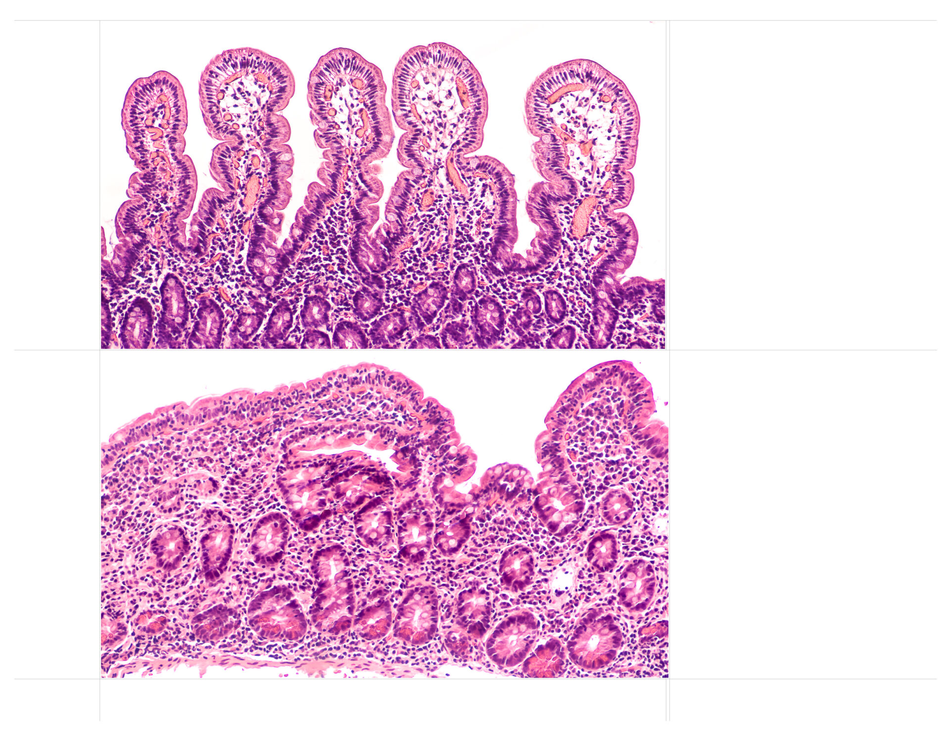 Celiac disease (sprue, gluten sensitive enteropathy) is an autoimmune disorder of the small intestine with diarrhea, bloating. Normal long villi (above) vs celiac disease (below) with blunted villi. AdobeStock 311592096