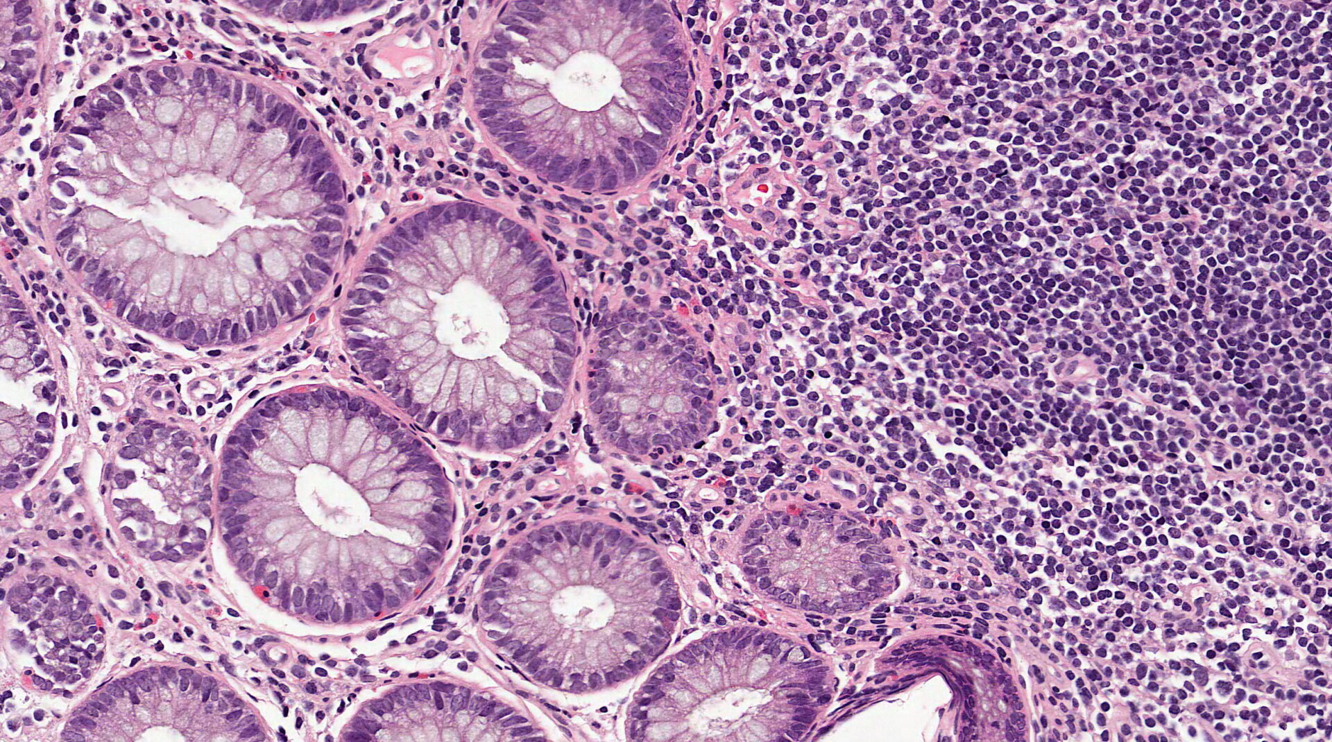 Mildly inflamed colonic mucosa - microscopic image 20x AdobeStock 372812412