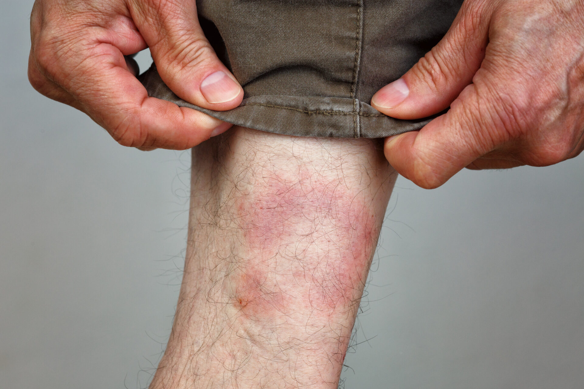 Symptom of Lyme Disease, Circular Expanding Rash, Erythema Migra AdobeStock 118376953