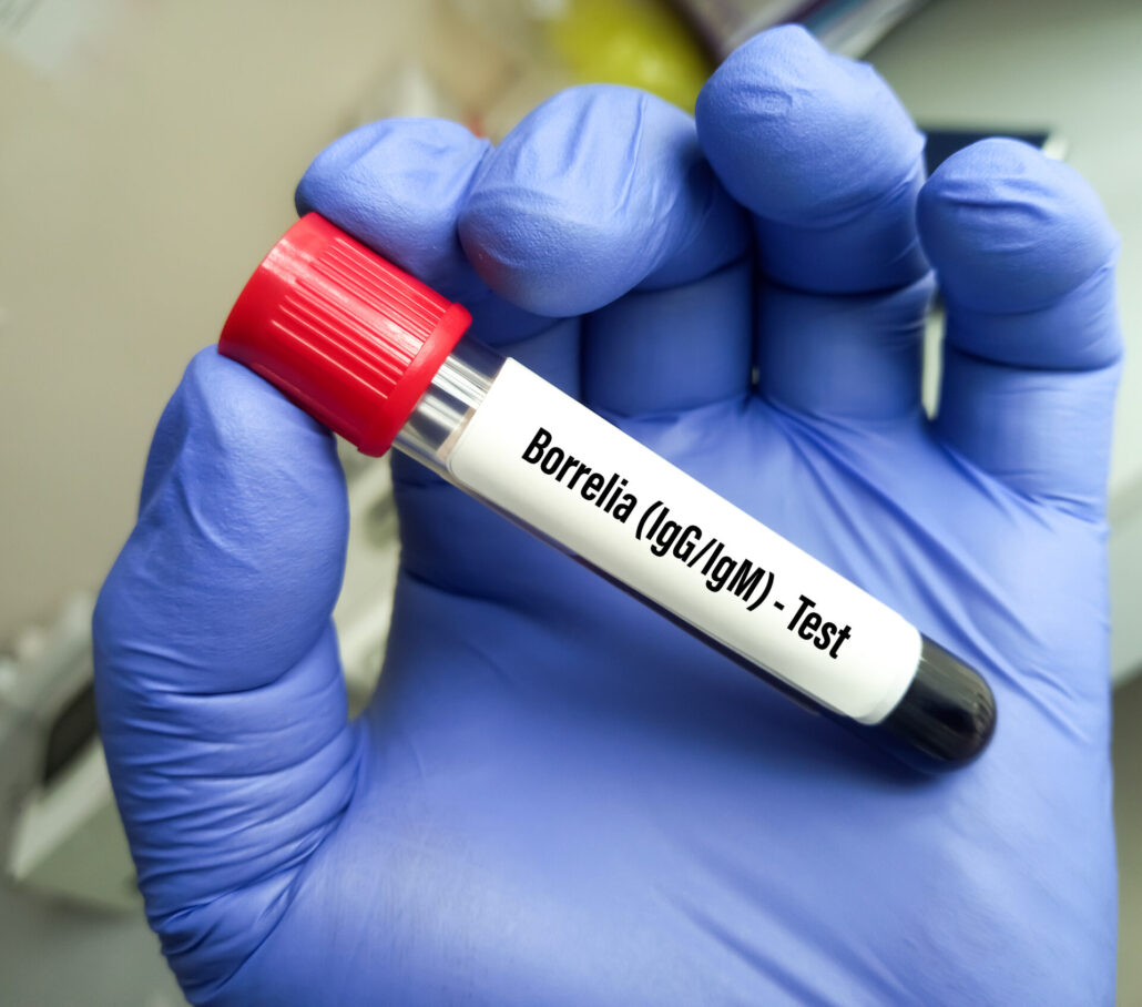 Blood sample tube for Borrelia IgG and IgM test, Lyme disease diagnosis. AdobeStock 510170220