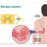 Varicella zoster virus CNS infection antibody index testing Reiber formula Intrathecal antibody detection