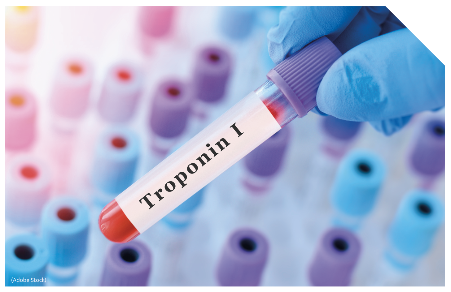 Benefits of high-sensitivity troponin I assays in light-chain ...