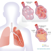 Recent data shows a role for PCSK9 in acute respiratory distress syndrome and sepsis 5 Acute respiratory