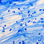 Alterations in the proteome exist before and for years after clinical tuberculosis disease 6 Sputum smear positive