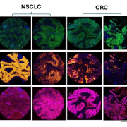Pharmacodynamic assessment of MET tyrosine kinase activation in tumour cells could aid personalized cancer treatment 3 MET Multiplex IFA Image 1 crop